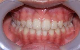 Khớp cắn chuẩn