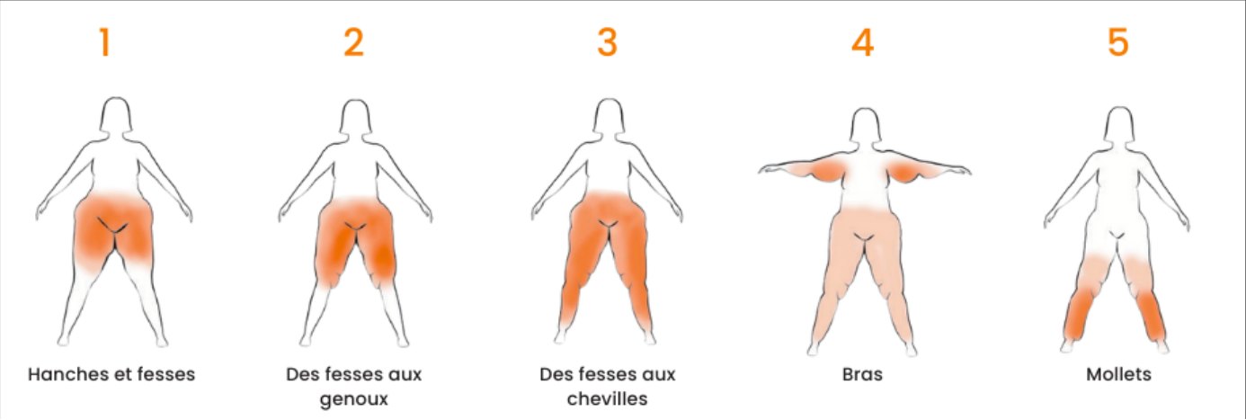 Les différents types de lipœdème en fonction de la zone touchée – illustration d’Alexandre Campos Moraes Amato