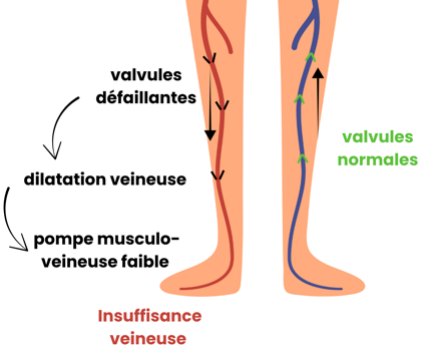 Valvules défaillantes, dilatation veineuse et pompe musculo-veineuse faible dans l’insuffisance veineuse