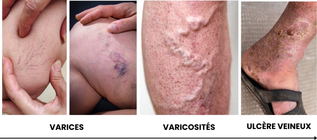 Insuffisance veineuse : comment le drainage lymphatique manuel peut-il aider ?