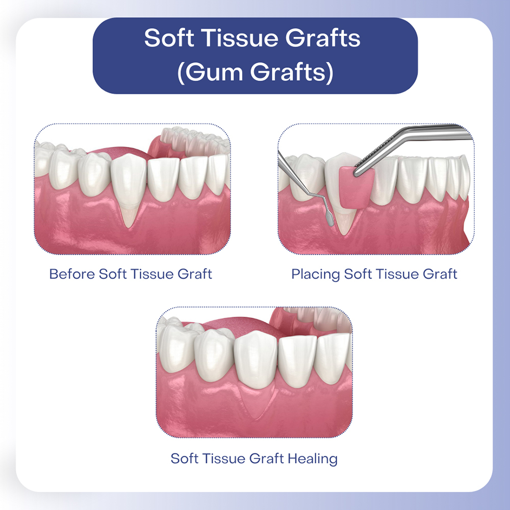 Gum Grafting diagram