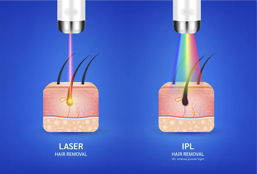 Perbedaan Antara IPL vs Laser untuk Menghilangkan Bulu dan Flek di Wajah