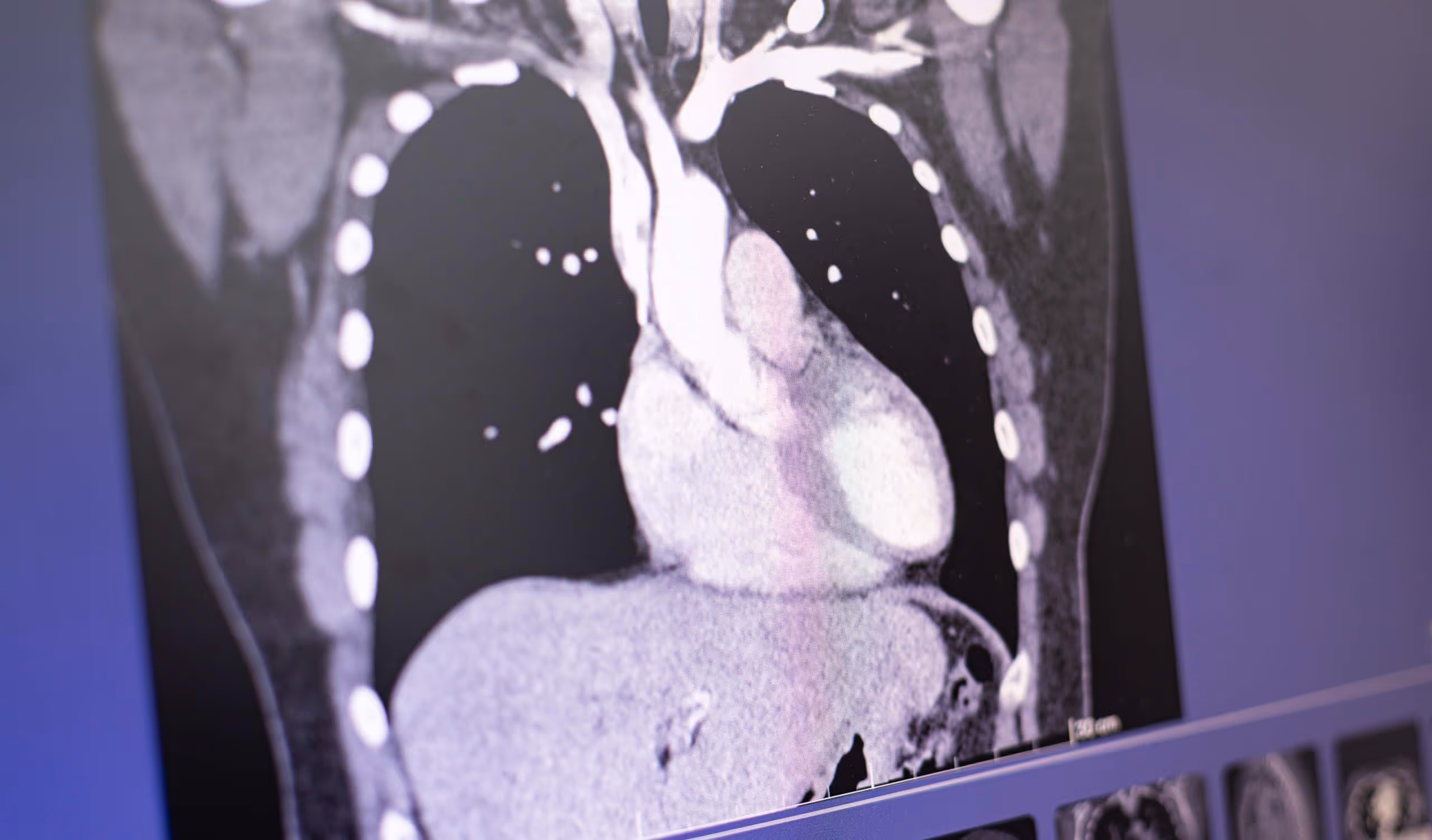 CT-Scan-Bild des Brustkorbs mit sichtbarem Herzen und umliegenden Strukturen.