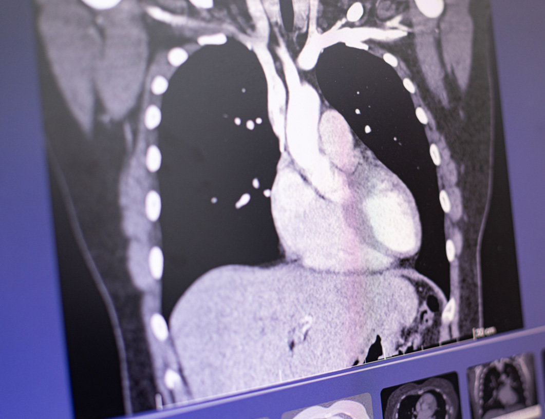 Computertomographie eines menschlichen Brustkorbs mit sichtbarem Herzen und umliegenden Organen.