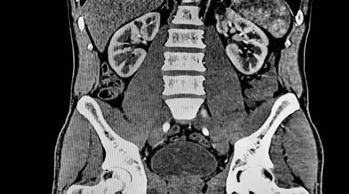 Coronal CT scan showing abdominal region with kidneys, spine, and pelvic bones.