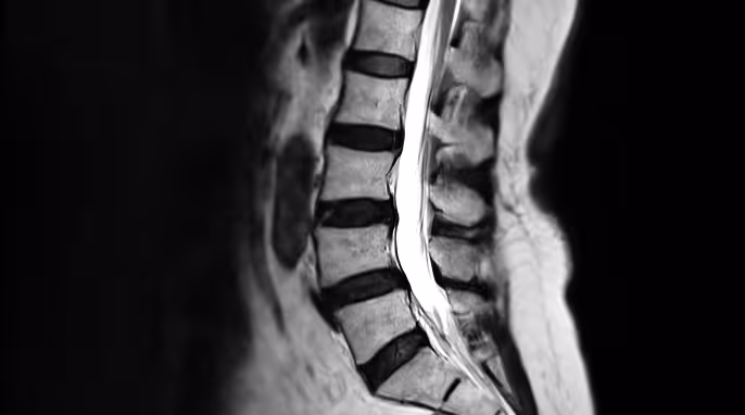 Sagittal MRI scan showing the lumbar spine with vertebrae and intervertebral discs clearly visible.