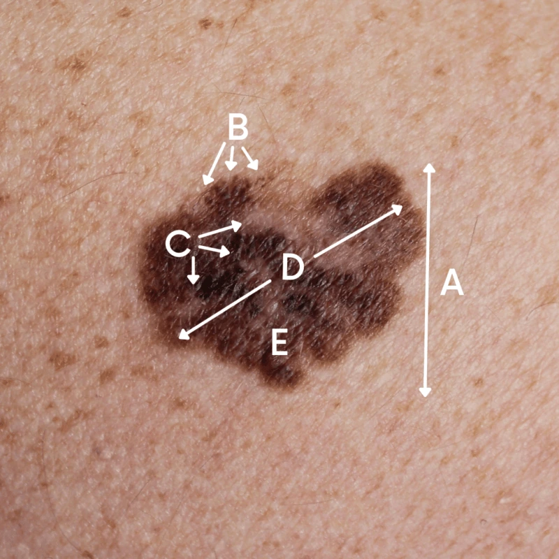 Close-up image of a suspicious mole on human skin labeled with the ABCDE rule for melanoma detection.