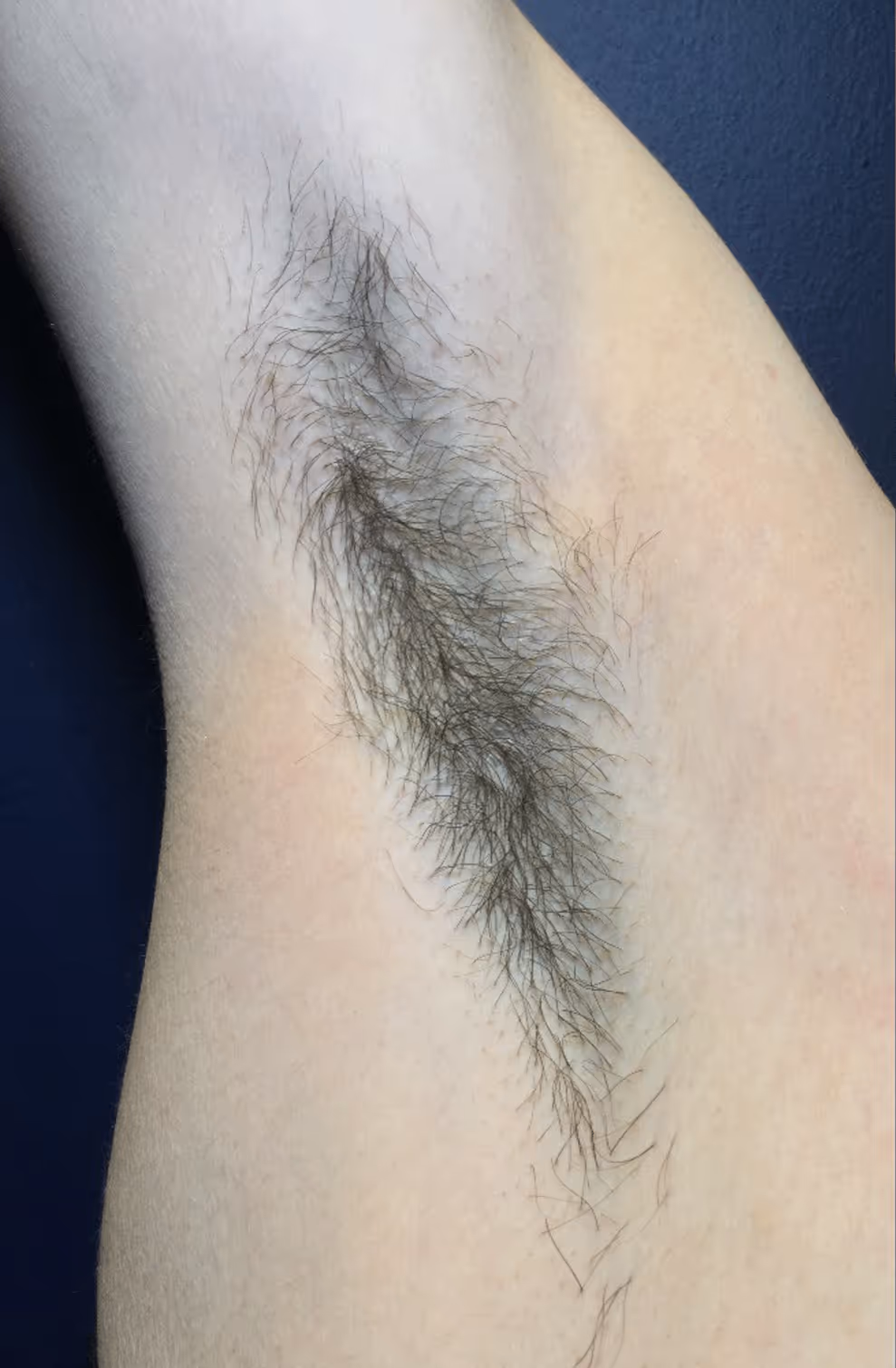 Before underarm laser hair removal at WaxKitty Toronto with fusion laser hair removal system from InMode. The hair is dark on underarms and dense with type 2 skin to fitzpatrick scale