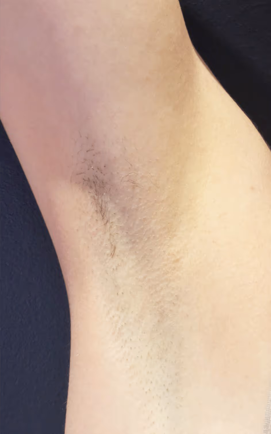 After underarm laser hair removal at WaxKitty Tornto. The hair is 95% removed only after 1 session.