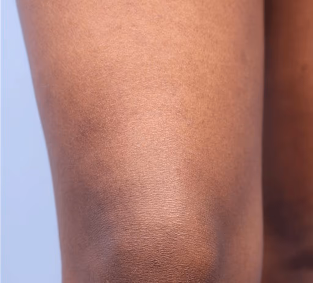 After image of thigh at WaxKitty Laser Hair removal TOronot on Type 6 skin on fitzpatrick scale after 5 sessions