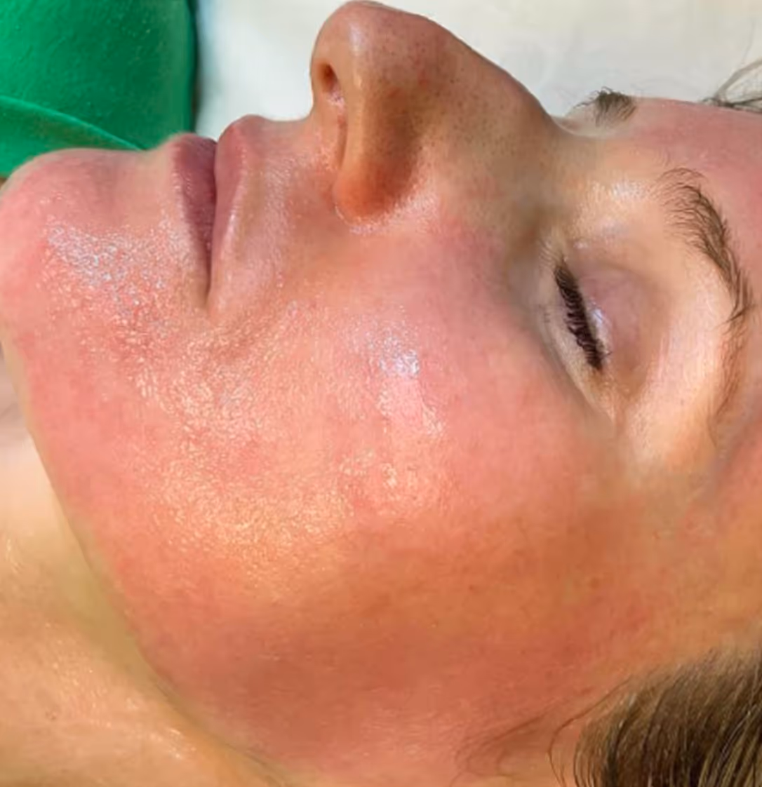 Post-laser inflammation and irritation before applying Glacial Rx