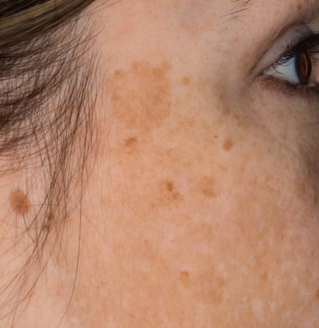 Sun damage and dark spots prior to cryotherapy with Glacial Rx