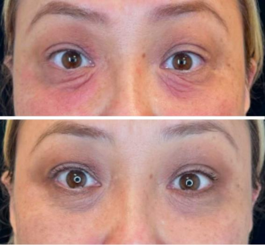 Fine lines and skin texture