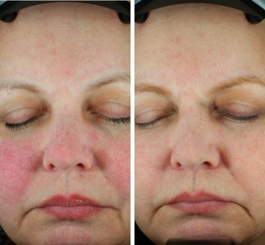 Fine lines and skin texture