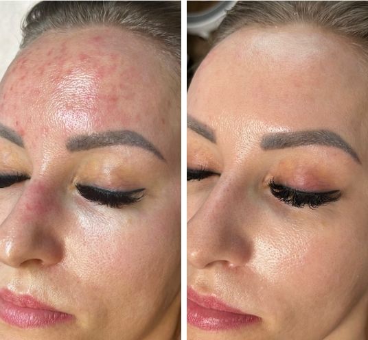 Fine lines and skin texture