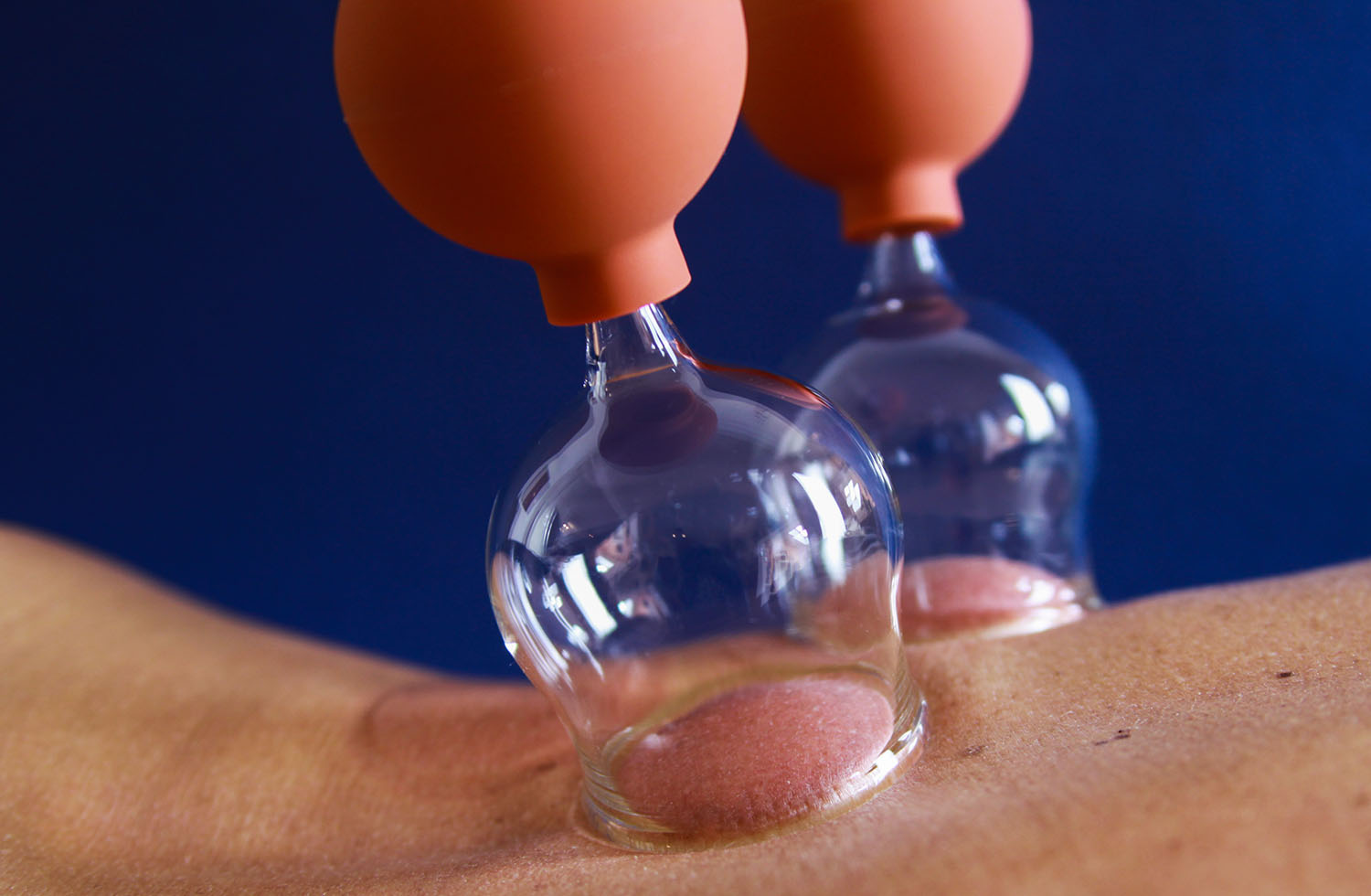 Glass suction cups with rubber bulbs placed on a client's skin during air cupping