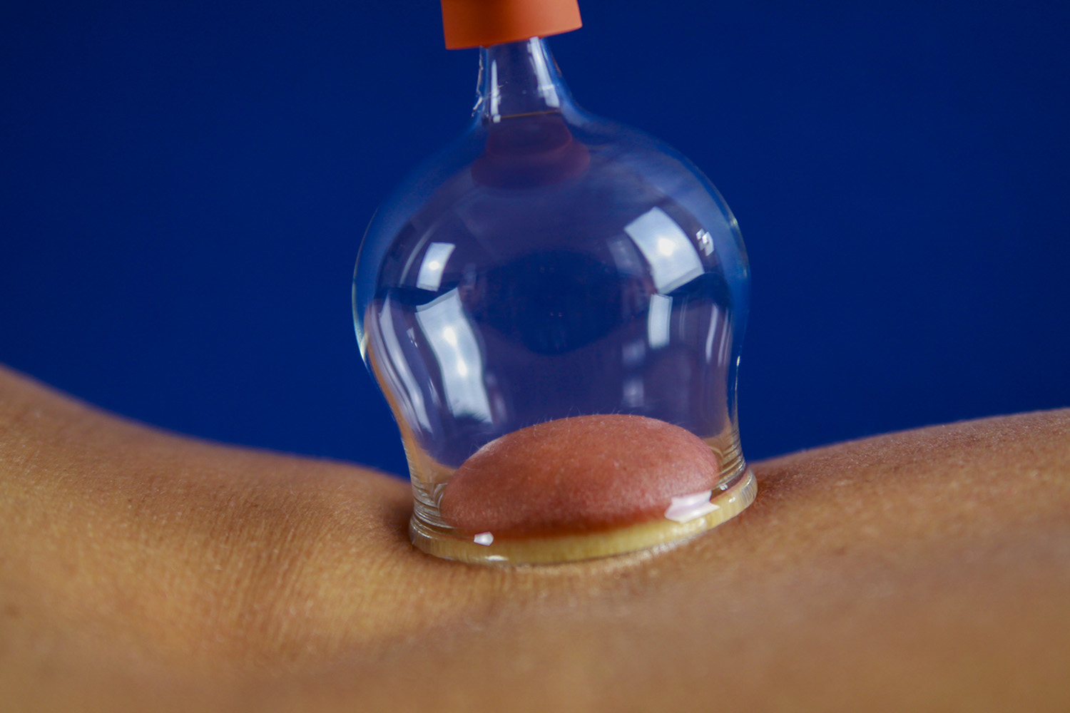 Close-up of a glass air cupping cup with a rubber bulb on a client's back