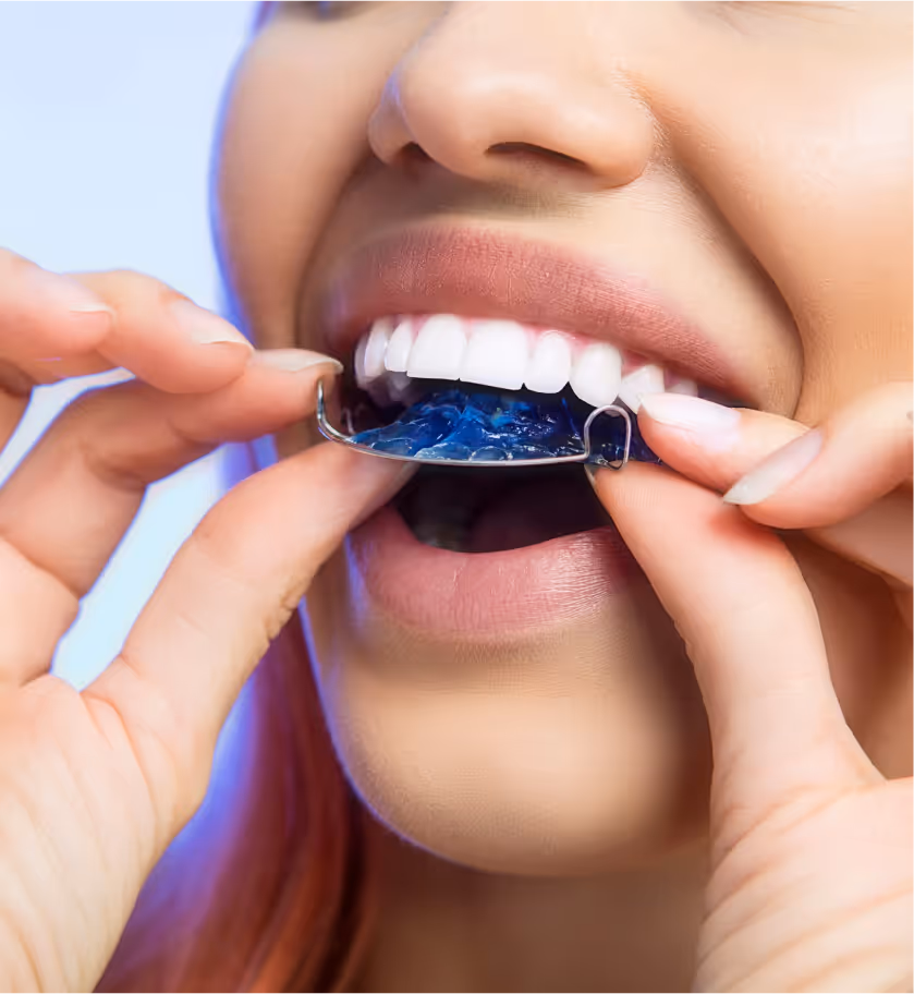 Close-up of a person inserting a blue orthodontic retainer to their upper teeth.