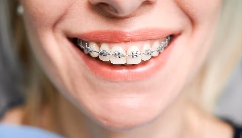 Close-up of a smiling person with metal braces on their upper teeth.