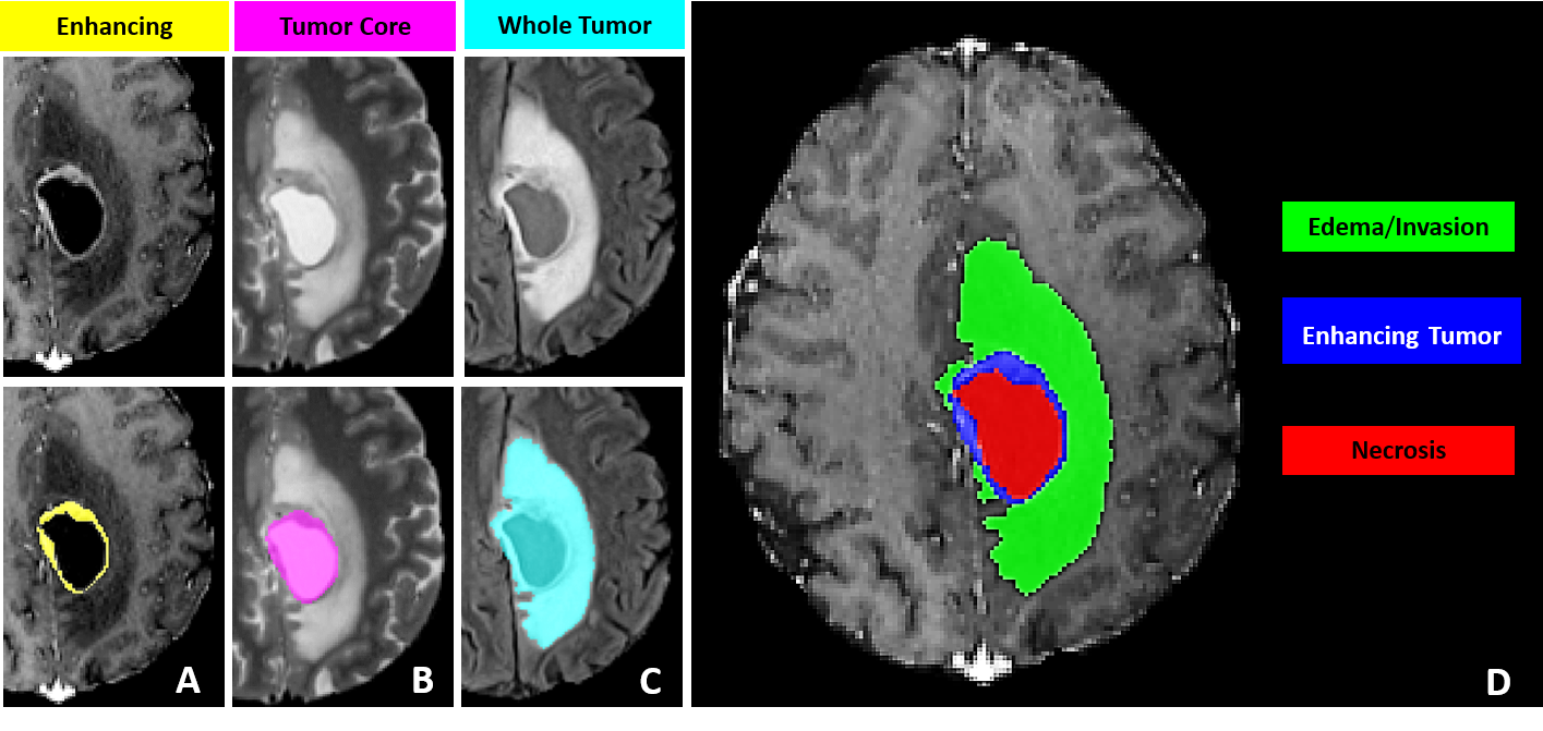 Brain MRI with multi-class tumor segmentation showing enhancing tumor, core, and edema regions