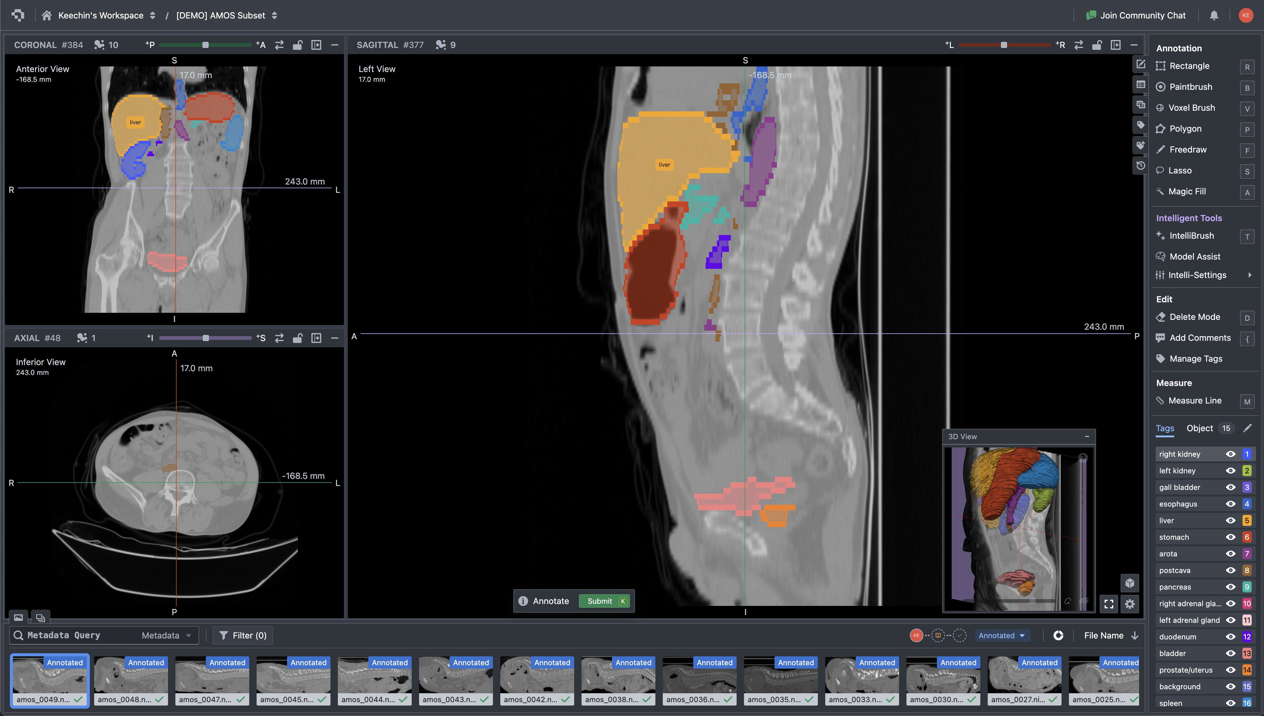 Multi-planar CT viewer with organ segmentation masks and annotation tools interface