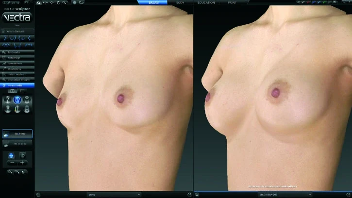 VECTRA Breast Sculptor interface comparing two 3D views with simulation controls