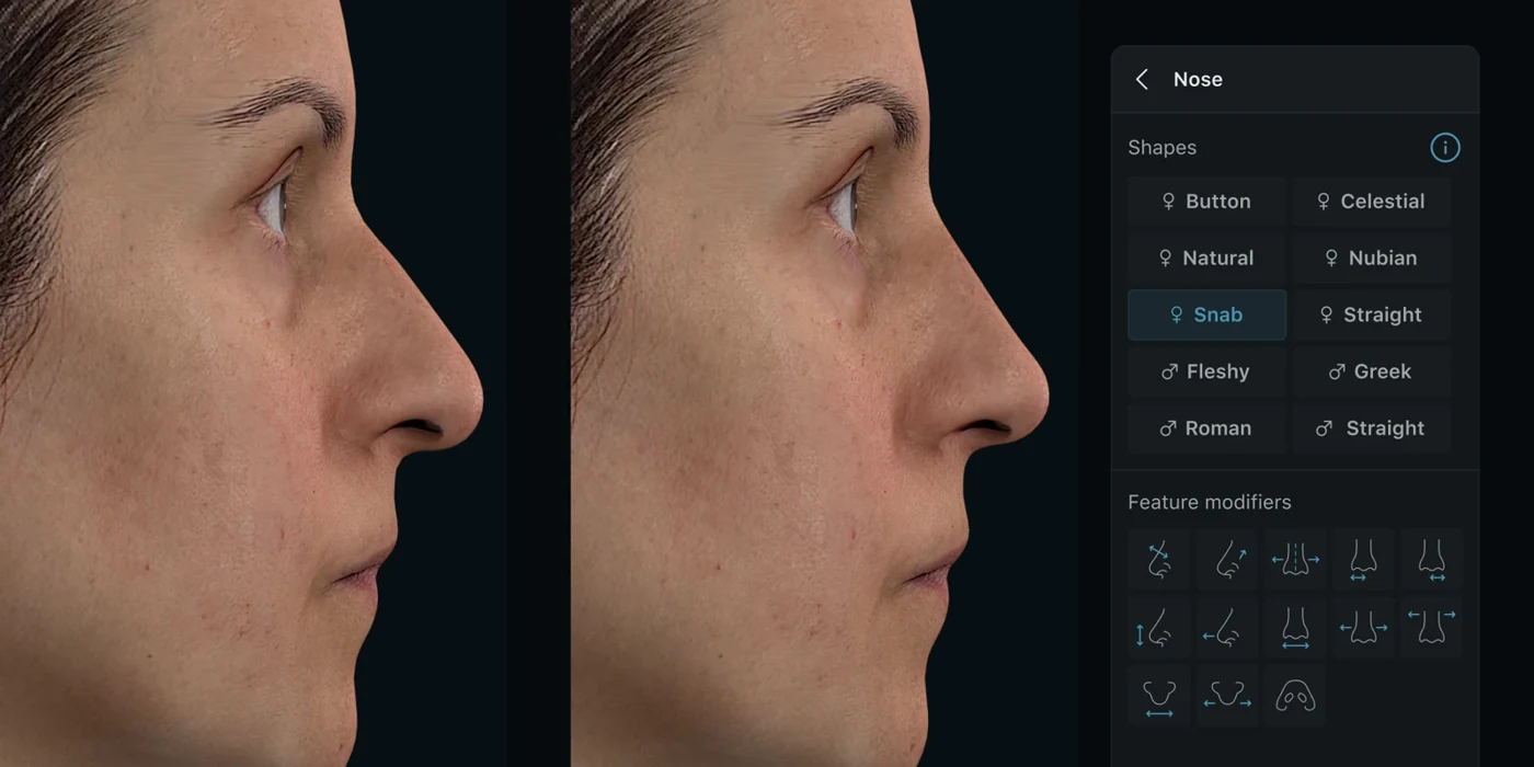 Crisalix facial simulation with nose shape presets and feature controls
