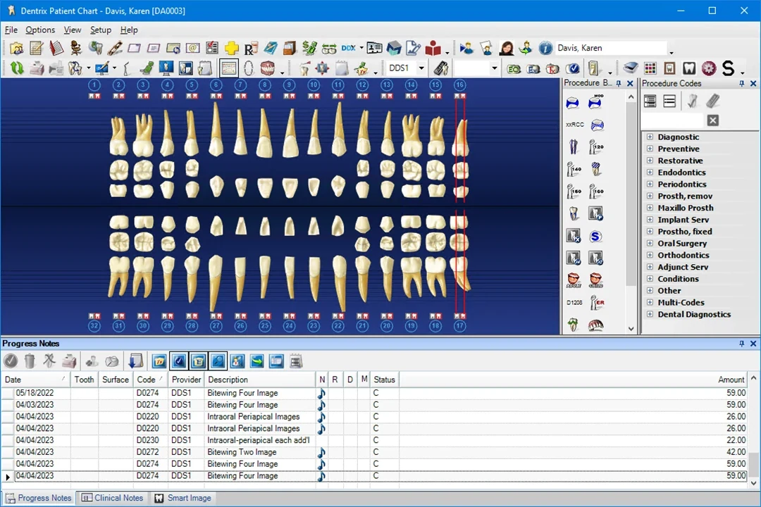 Dentrix Patient Chart with tooth chart, procedure code panels and progress notes table.