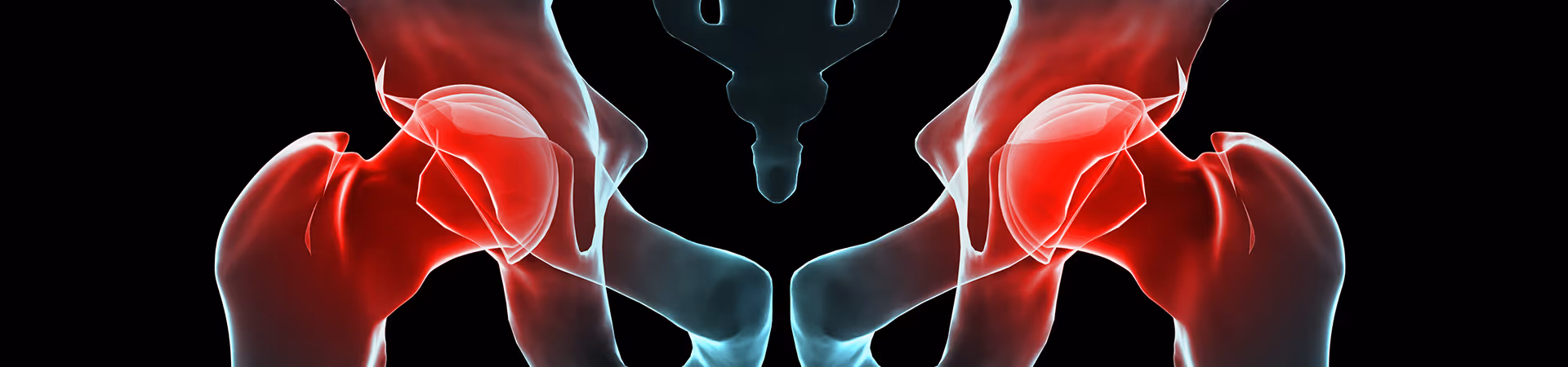 Hip Arthritis and Osteoarthritis