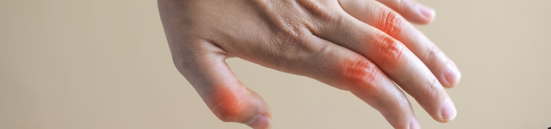 Rheumatoid Arthritis