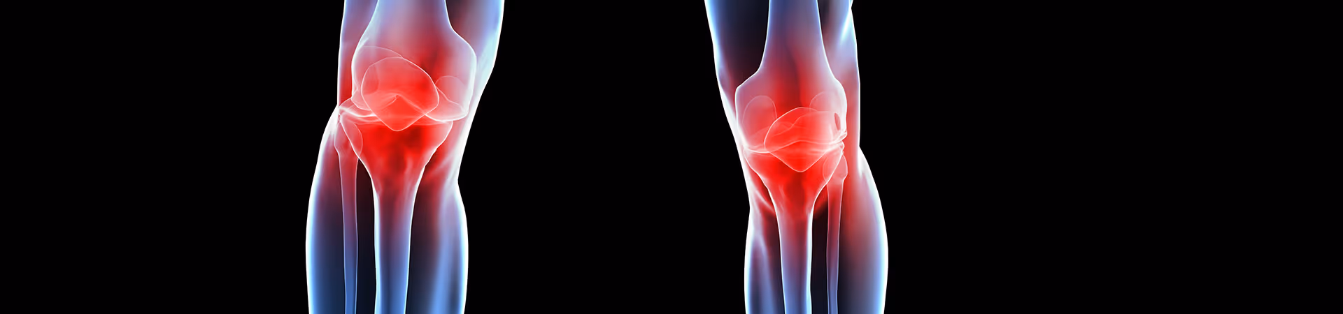Osteoarthritis