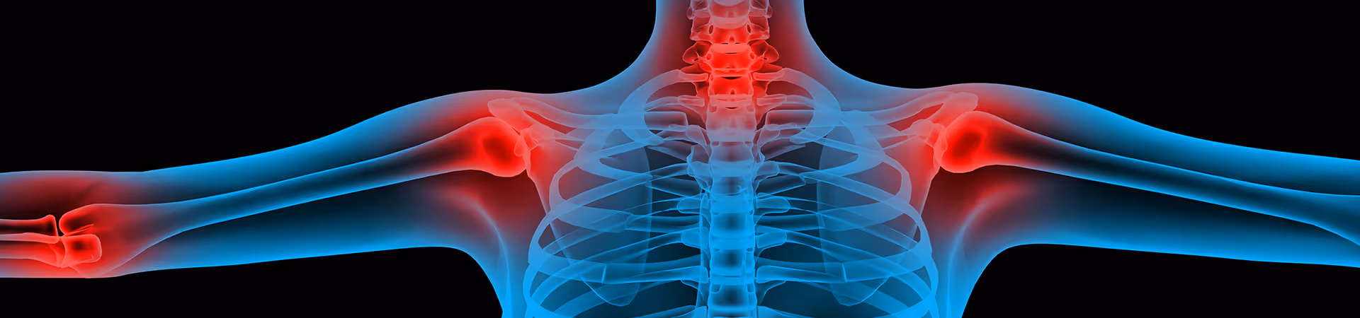 Arthritis