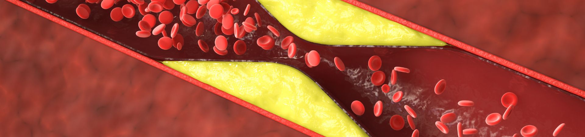 Peripheral Arterial Insufficiency