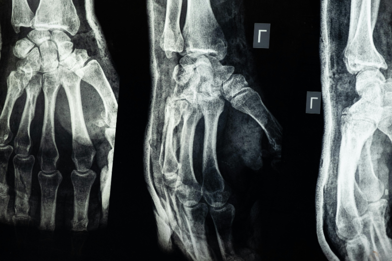 Crush Injuries, Limb Trauma & HBOT
