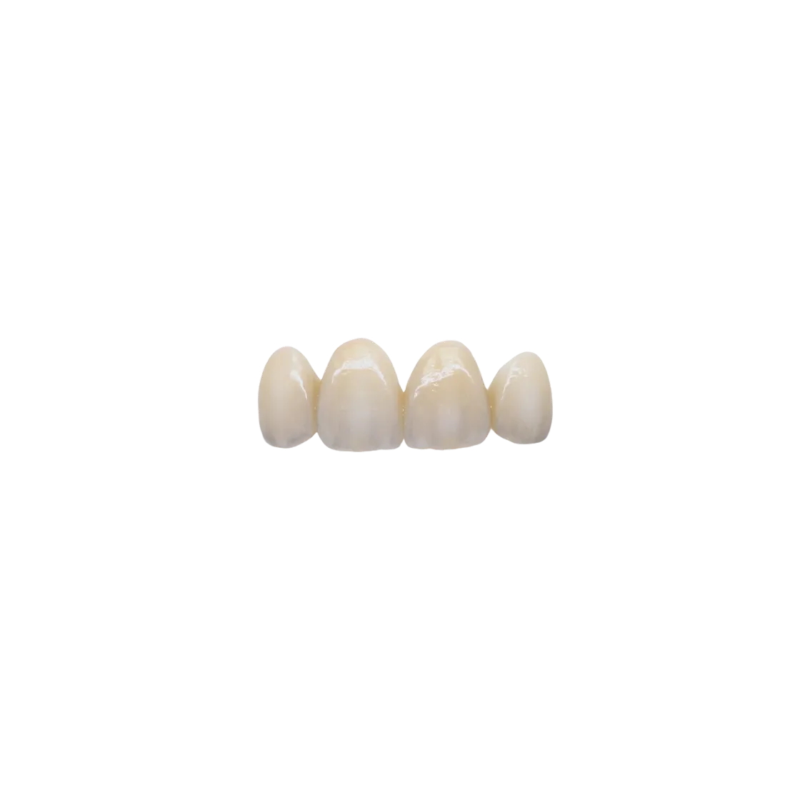 Close-up view of a zirconia esthetic bridge displaying natural-looking translucency and seamless tooth integration.