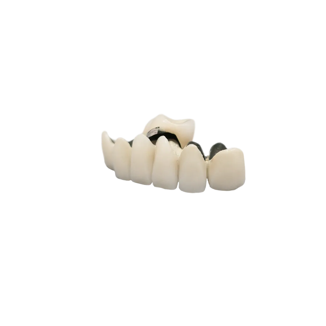 PFM crown with metal base and porcelain layering.