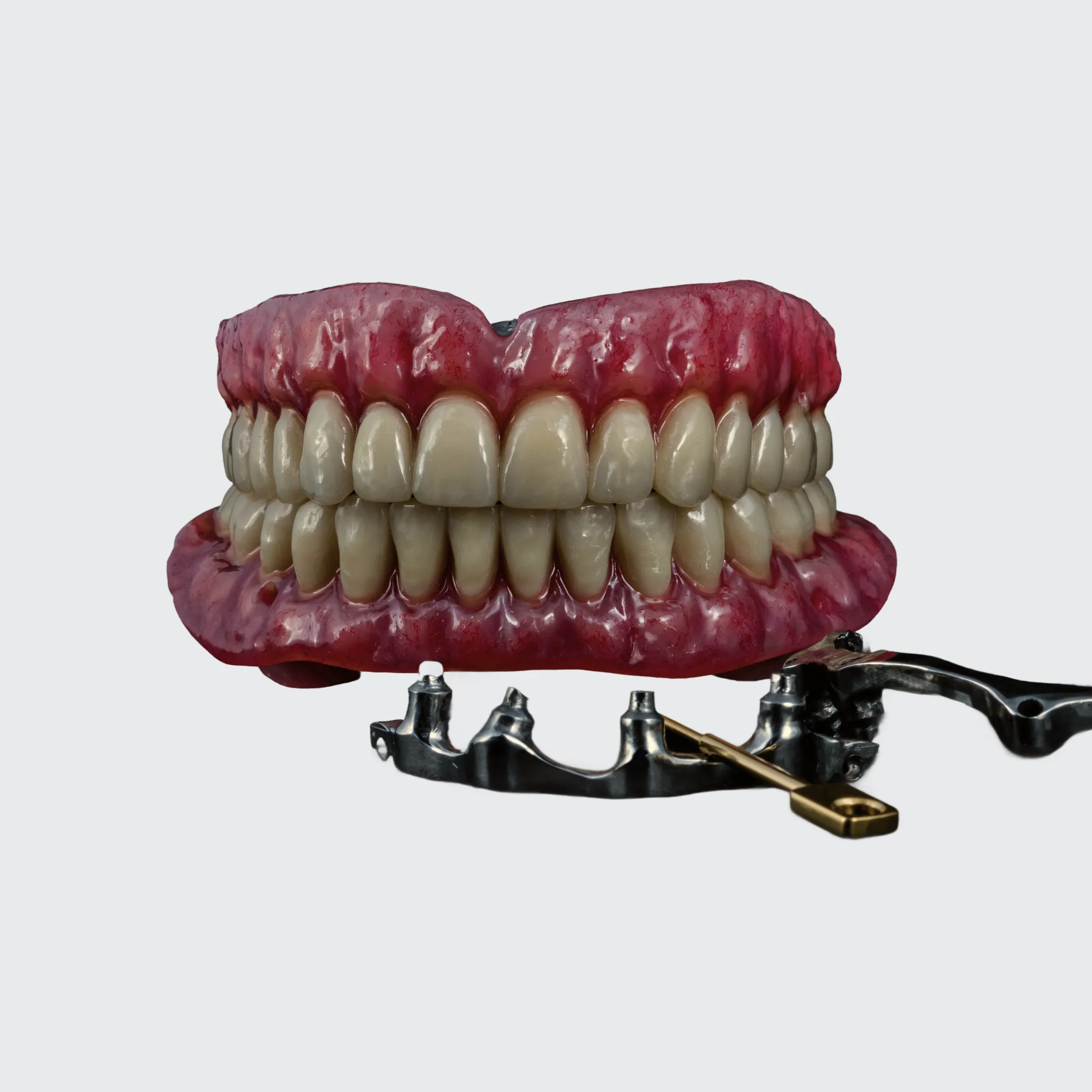 Bar supported overdenture