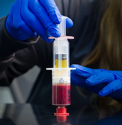A doctor wearing blue gloves extracts blood plasma from red blood cells in a centrifuge syringe.