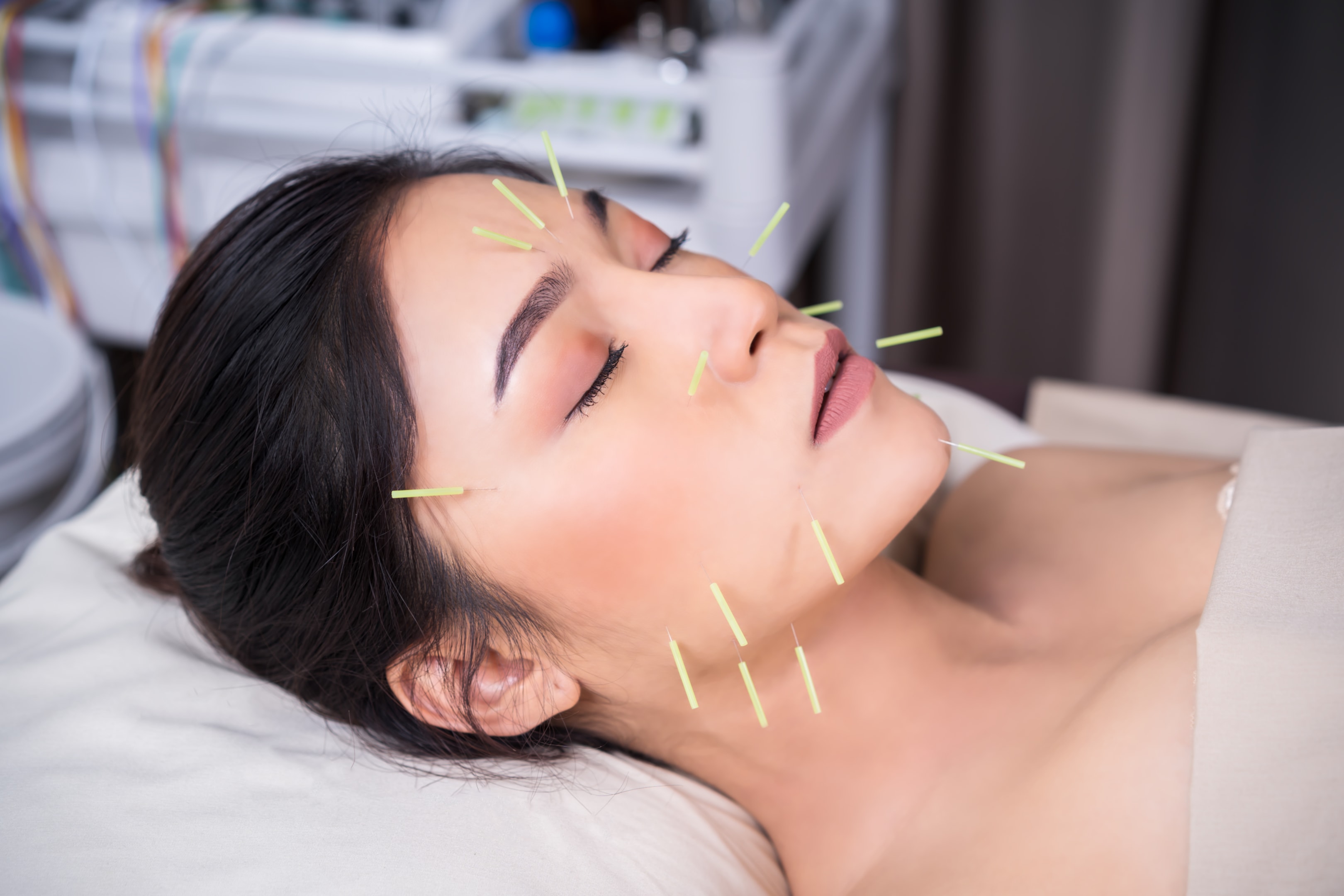 Woman lying on treatment table receiving facial acupuncture with thin needles placed on her face