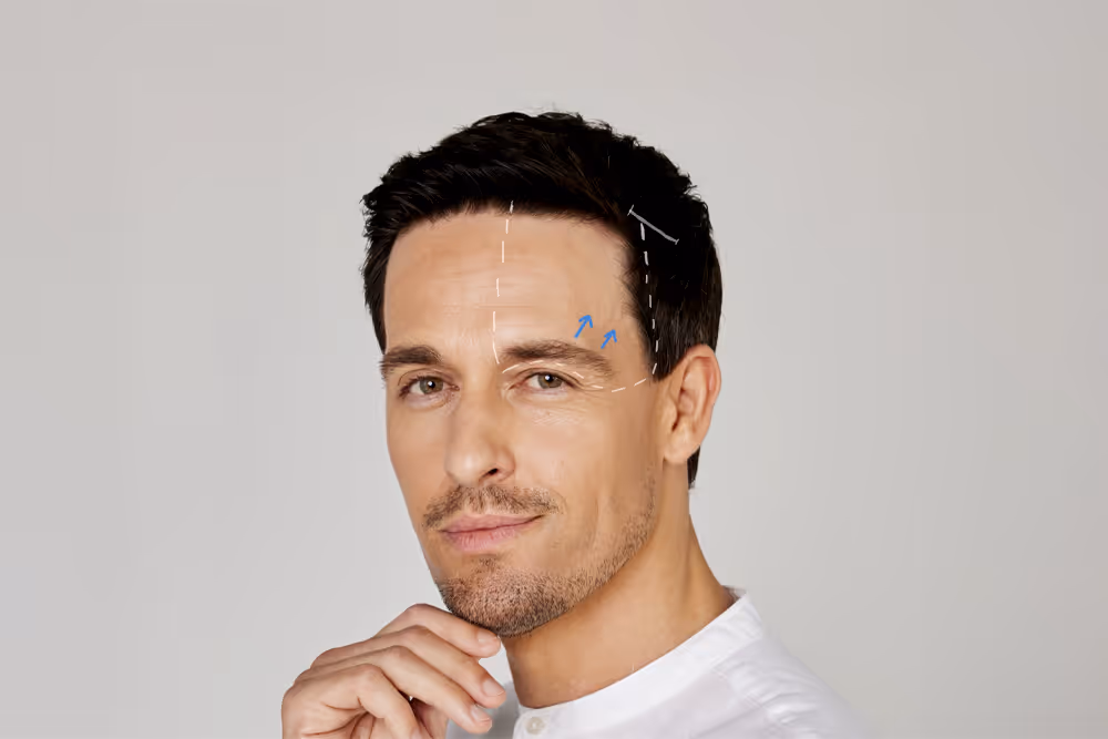 Mann mit kurzen dunklen Haaren in weißem Hemd; Linien und Pfeile markieren die Stirn für einen Browlift bei Dr. Berkei Praxis.