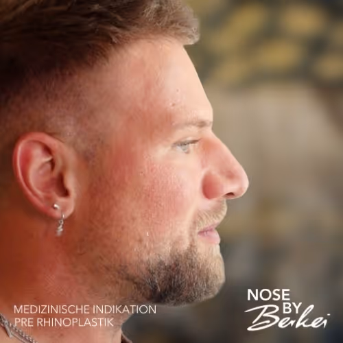 Profil eines Mannes vor einer Rhinoplastik mit Text 'Medizinische Indikation Pre Rhinoplastik' und Logo 'Nose by Berkei'.