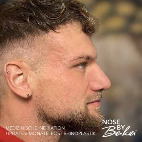 Seitenansicht eines Mannes mit kurzem, lockigem Haar und Bart, sechs Monate nach einer Nasenoperation.