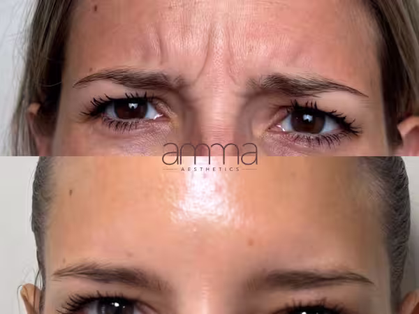 Injectables