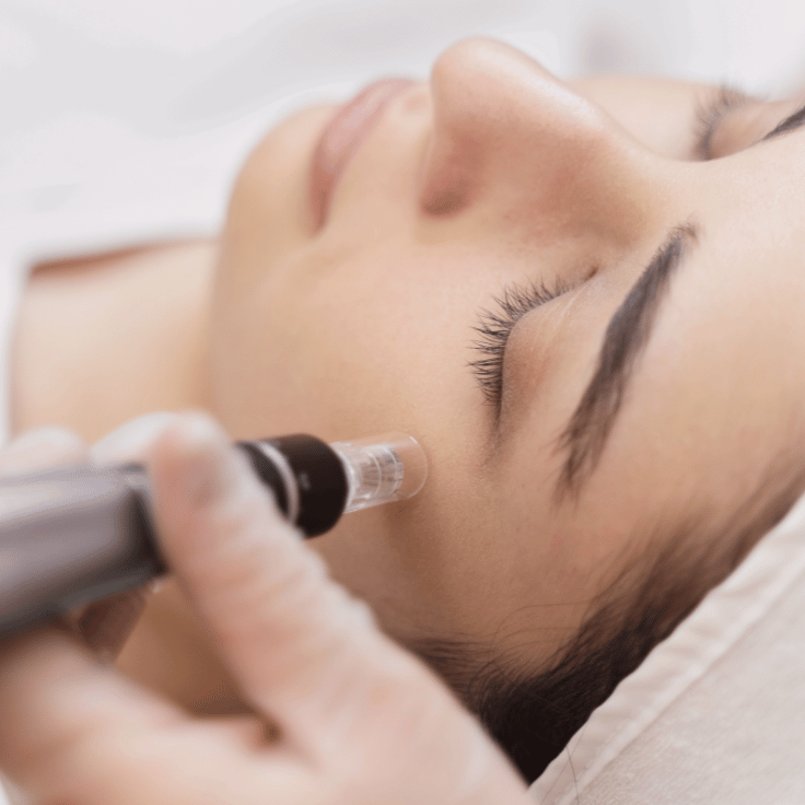 Microneedling