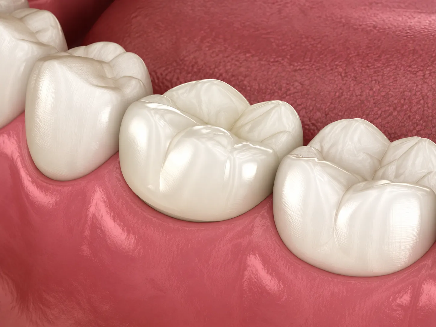 Collage showing close-up dental procedure steps: sanding tooth surface, polished teeth, and placing a dental veneer with tweezers.