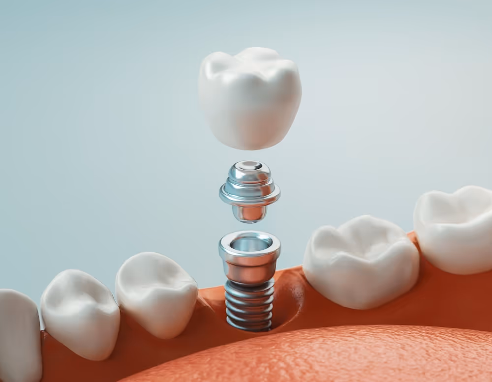 A dental model of a tooth and a dental implant.