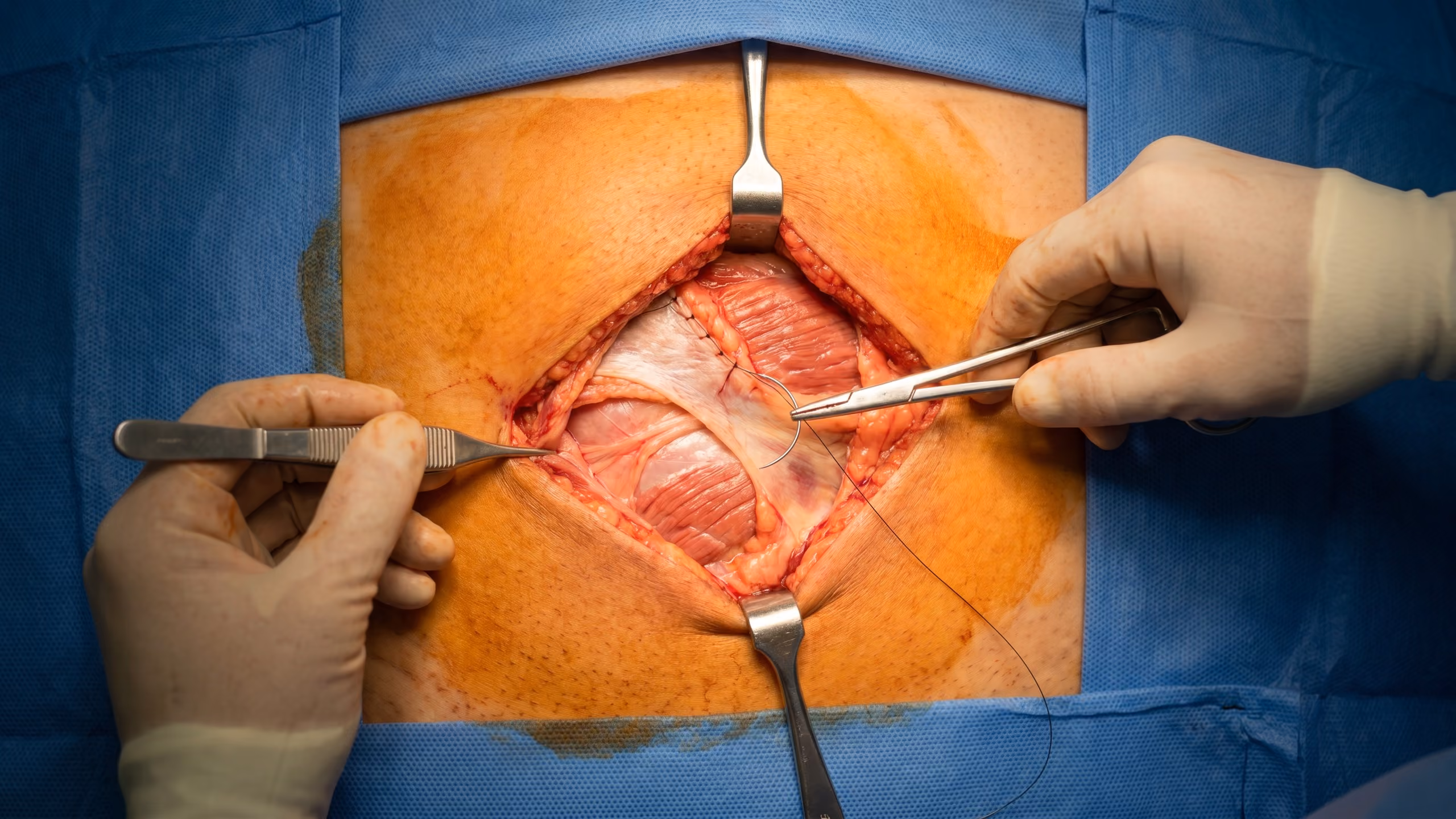Shouldice inguinal hernia repair surgical field showing layered tissue suture technique