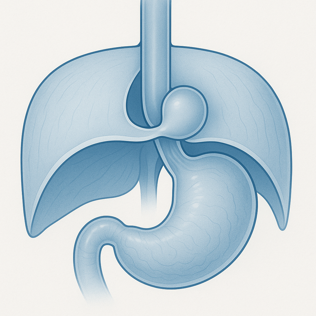 Hiatal Hernia