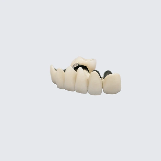Porcelain Fused Metal (PFM)