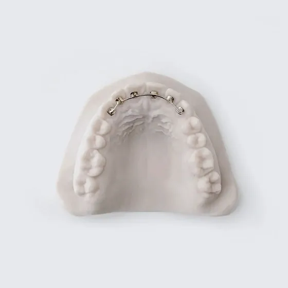 Lingual Retainer